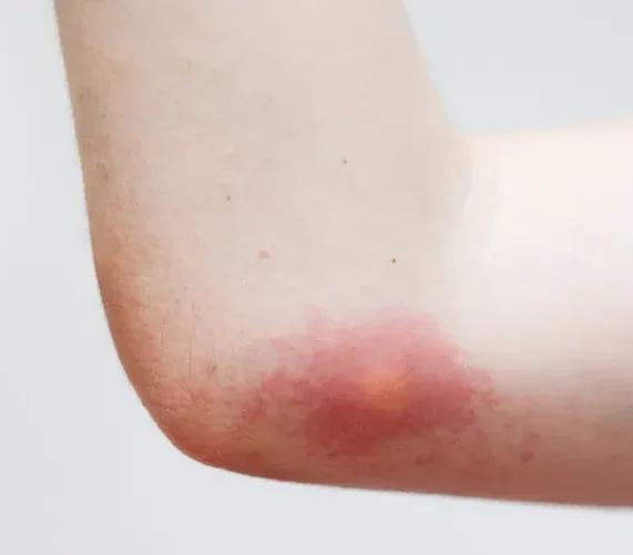 photo d'une piqûre de guêpe sur le bras d'une personne pour illustrer "que faire en cas de piqûre de guêpe".