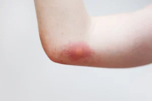 photo d'une piqûre de guêpe sur le bras avec un gonflement.