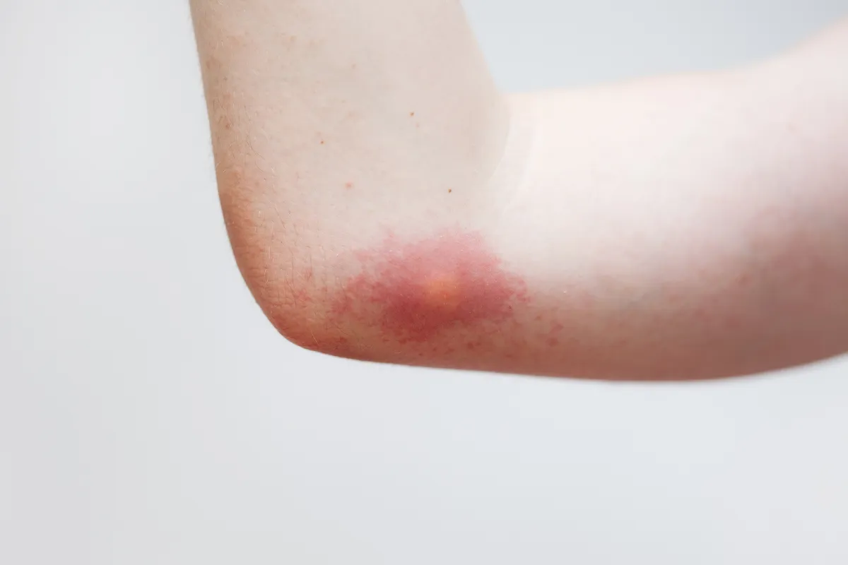 Réaction cutanée après une piqûre d'hyménoptère : rougeur et gonflement localisés
